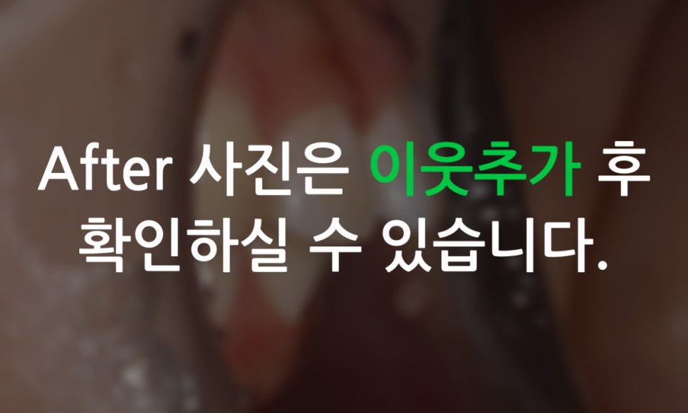 세라믹교정 앞니틀어짐 교정 사례 관련 이미지 12