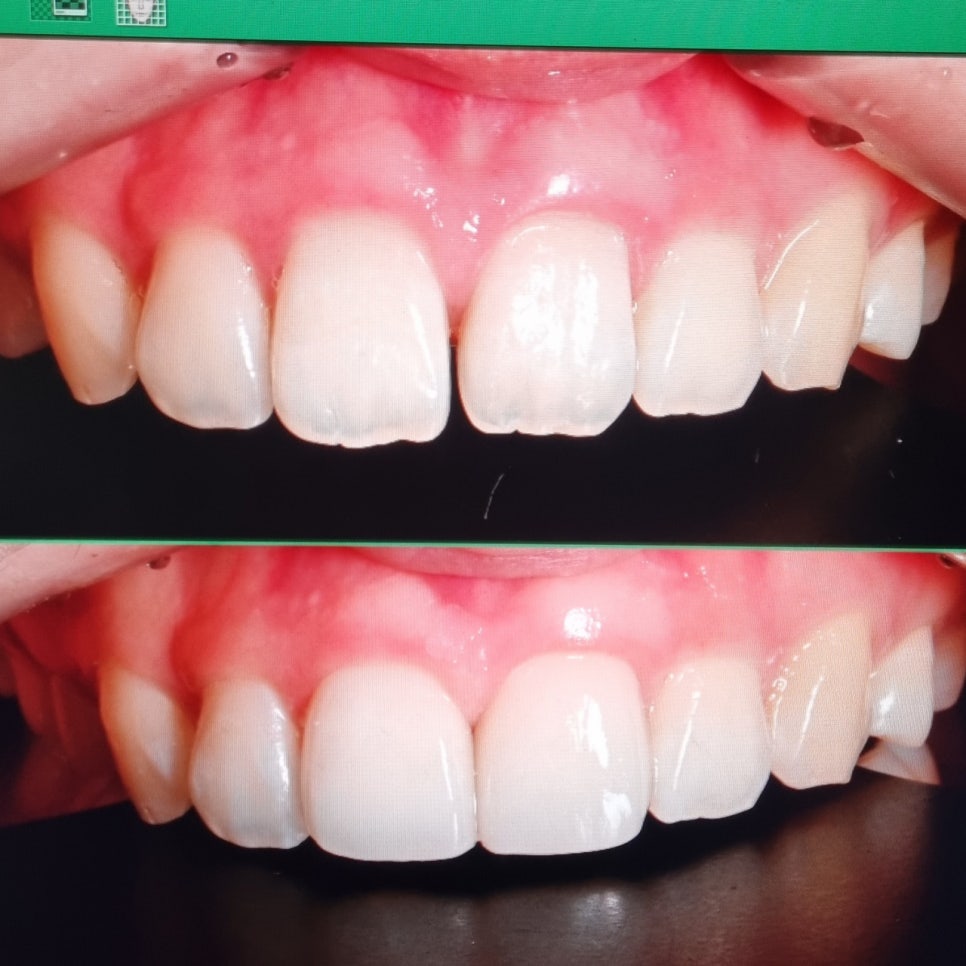 무삭제라미네이트후기 많은 고객님들의 찐후기가 많은 2D치과 관련 이미지 7