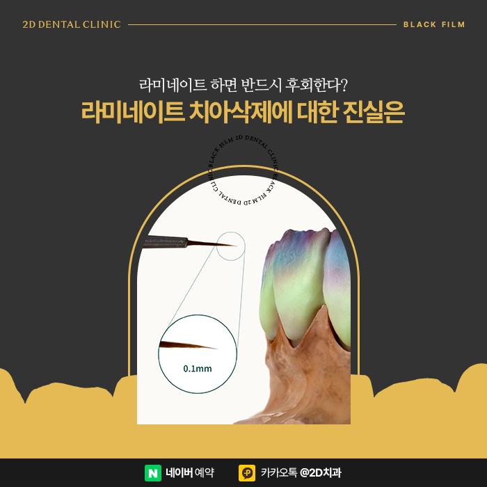 라미네이트 단점은 치아삭제? 강남 라미네이트전문 2D치과 블랙필름 관련 이미지 2