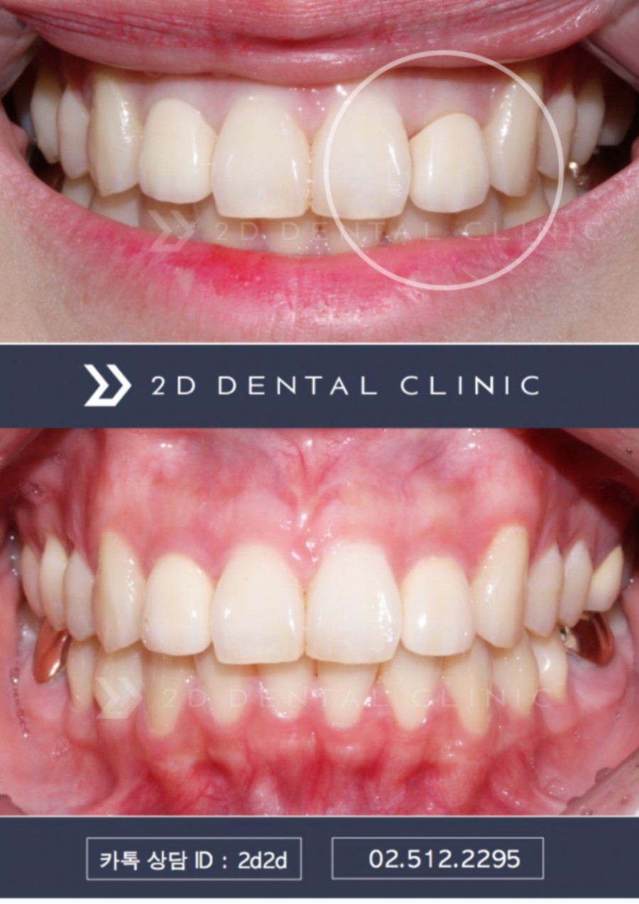 오래된 앞니 블링스로 다시 씌우기 :: 강남역 투디치과 관련 이미지 4