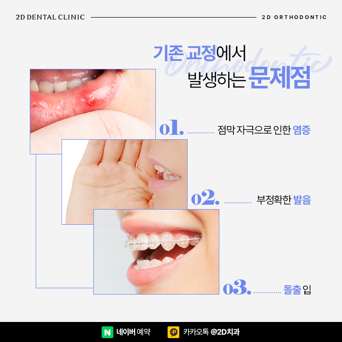 투디교정으로 앞니 모양 개선! 논현역 2D교정 관련 이미지 2
