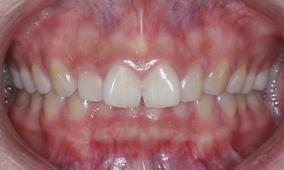 나비치아교정, 부분 치아교정으로 하고 싶다면? by.투디치과(2D치과) 관련 이미지 5