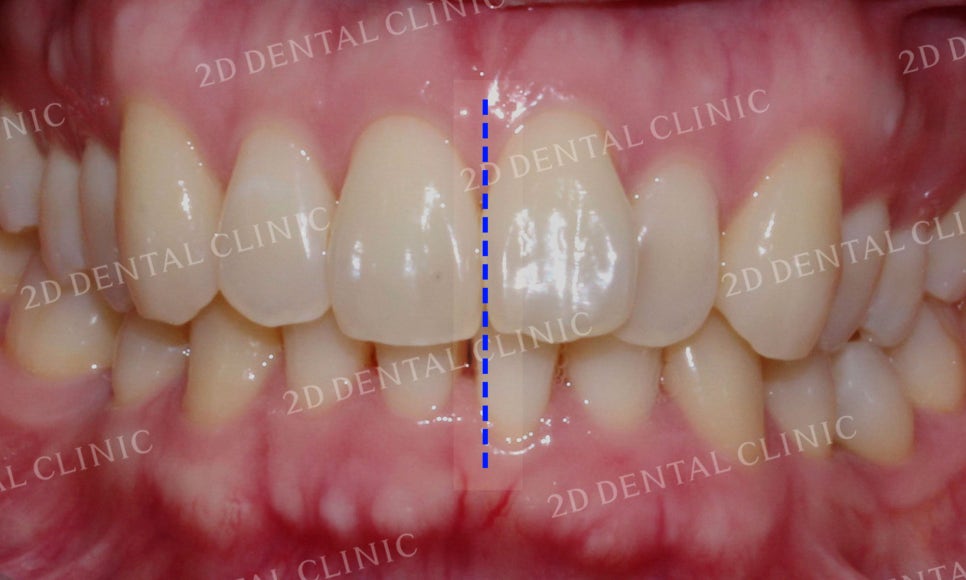 [투디교정] 부정교합 앞니교정을 투디교정으로 고르게! by.투디치과(2D치과) 관련 이미지 13