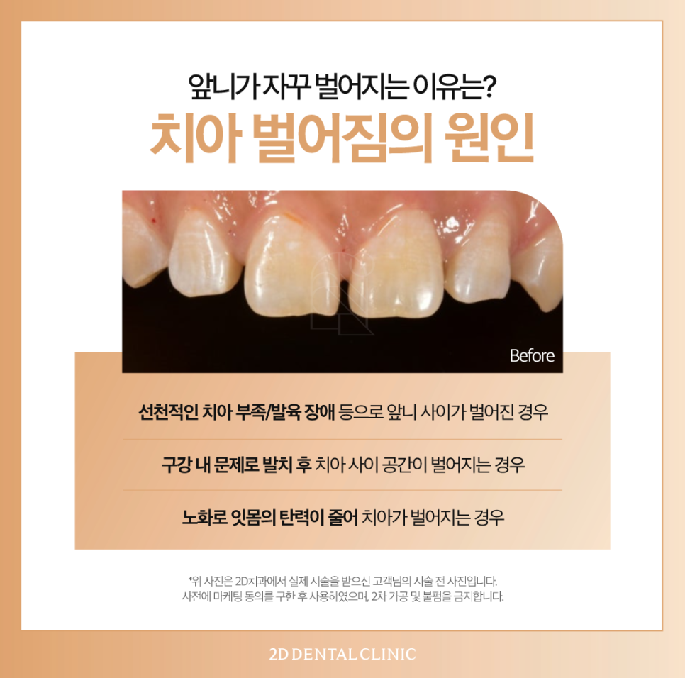 무삭제라미네이트가격 치아미백치과 앞니 고민 있다면 관련 이미지 3