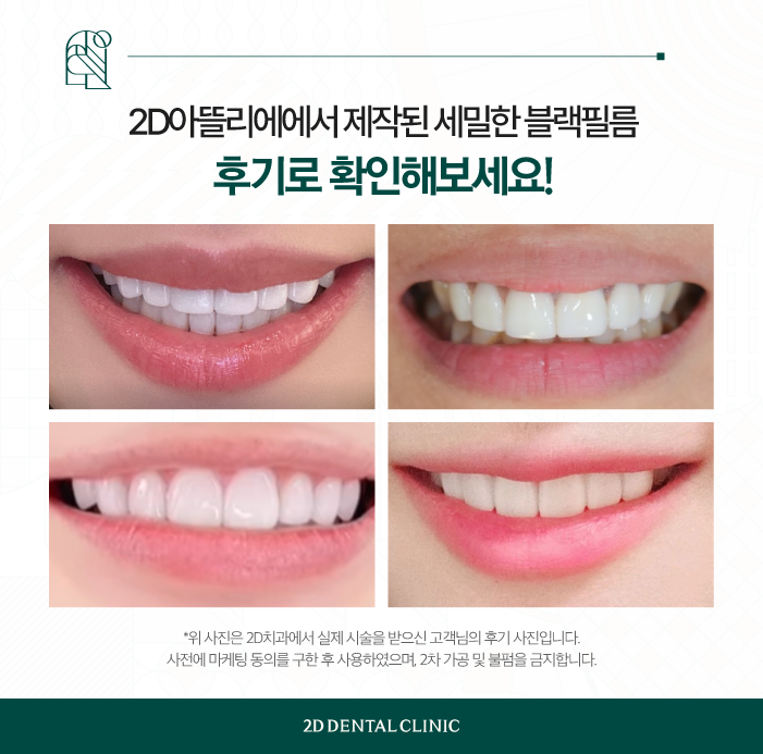 무삭제 라미네이트 블랙필름 제작은 어디서? 투디치과 아뜰리에! 관련 이미지 6