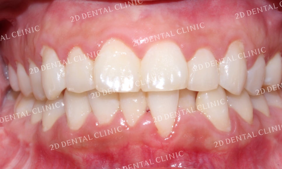 [투디교정] 덧니치아교정, 부분교정으로 쉽고 빠르게! by.투디치과(2D치과) 관련 이미지 5