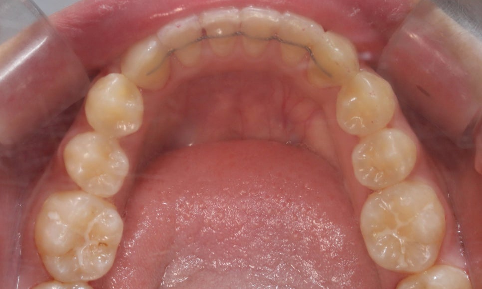 톱니모양 치아를 매끄러운 치아모양으로 개선하는 방법! (마멜론치아) 관련 이미지 10