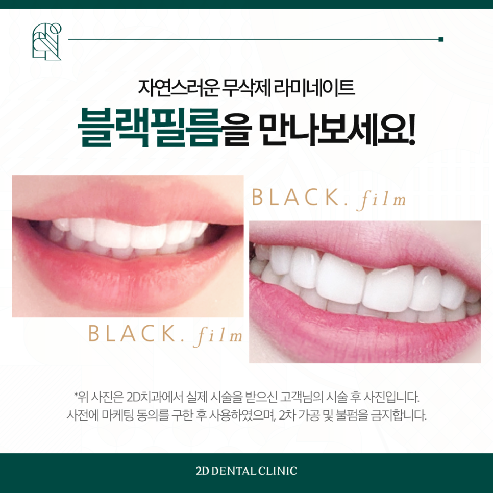 치아무삭제라미네이트 투디치과 나에게 꼭 맞는 블랙필름 관련 이미지 8