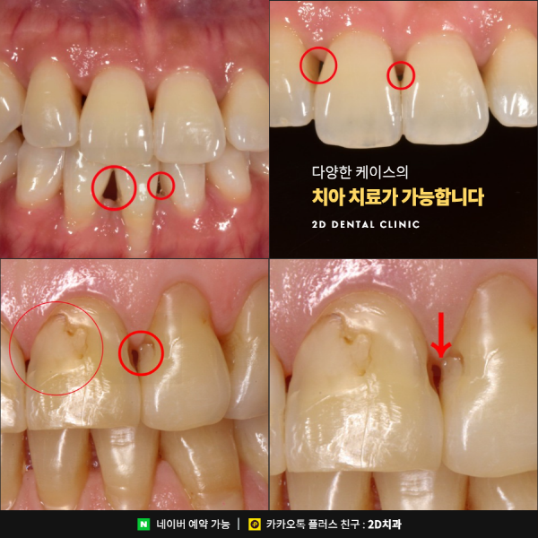 앞니깨짐, 치아변색 앞니고민 해결사! <세라필름 &middot; 블랙필름> 관련 이미지 3