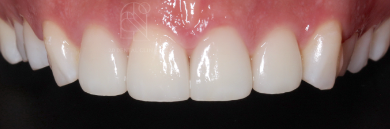 무삭제라미네이트부작용 블랙필름과 비교 관련 이미지 3