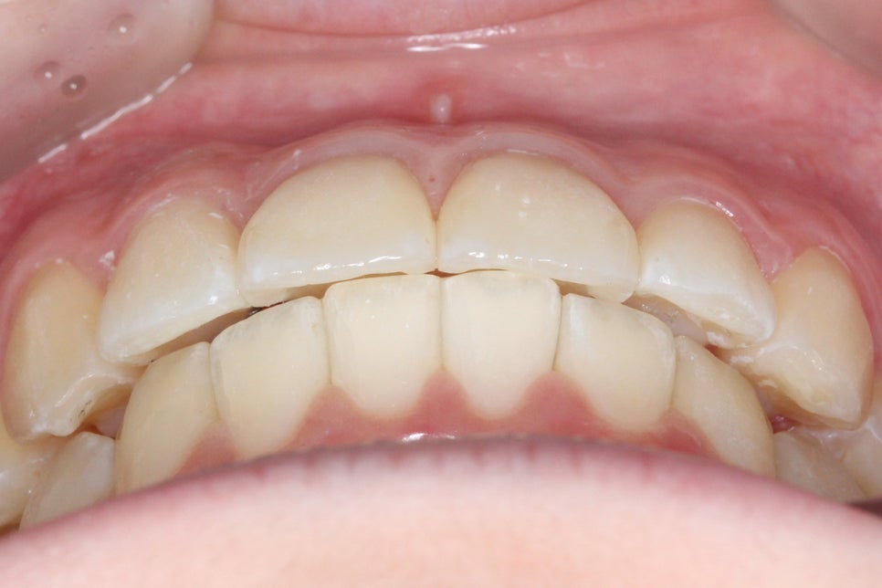 투디치과 송곳니덧니 치료 후기 관련 이미지 9