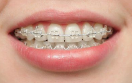 만족도 높은 치아삭제 없는 무삭제라미네이트후기 관련 이미지 3