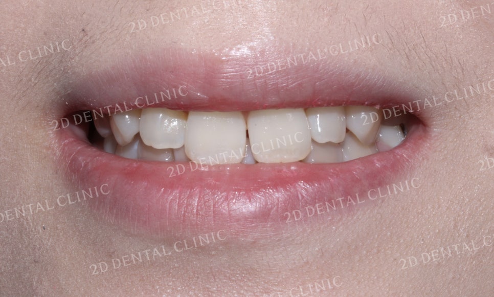 나비치아교정, 부분교정으로 나비치아 탈출하기! by.투디치과(2D치과) 관련 이미지 10