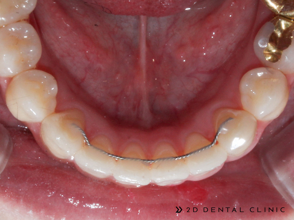 케이스로 확인하는 덧니 부정교합, 교정전문 2D치과 관련 이미지 9