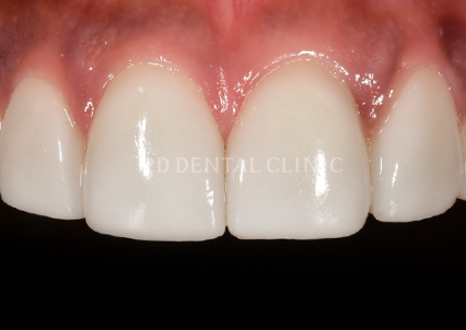 치아교정과 무삭제라미네이트 블랙필름 나에게 맞는 시술찾기 관련 이미지 7