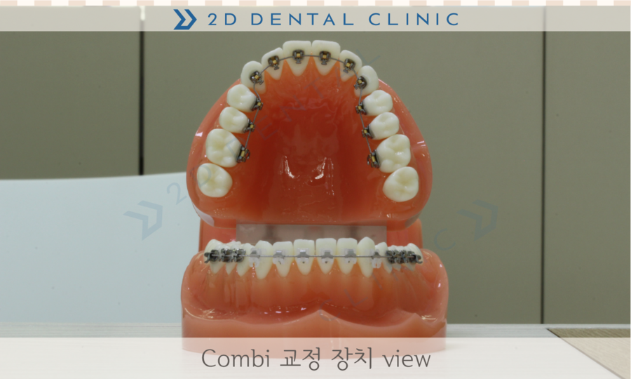 [교정상식] 설측교정,투명교정,콤비교정 장치종류 및 장단점! 관련 이미지 7