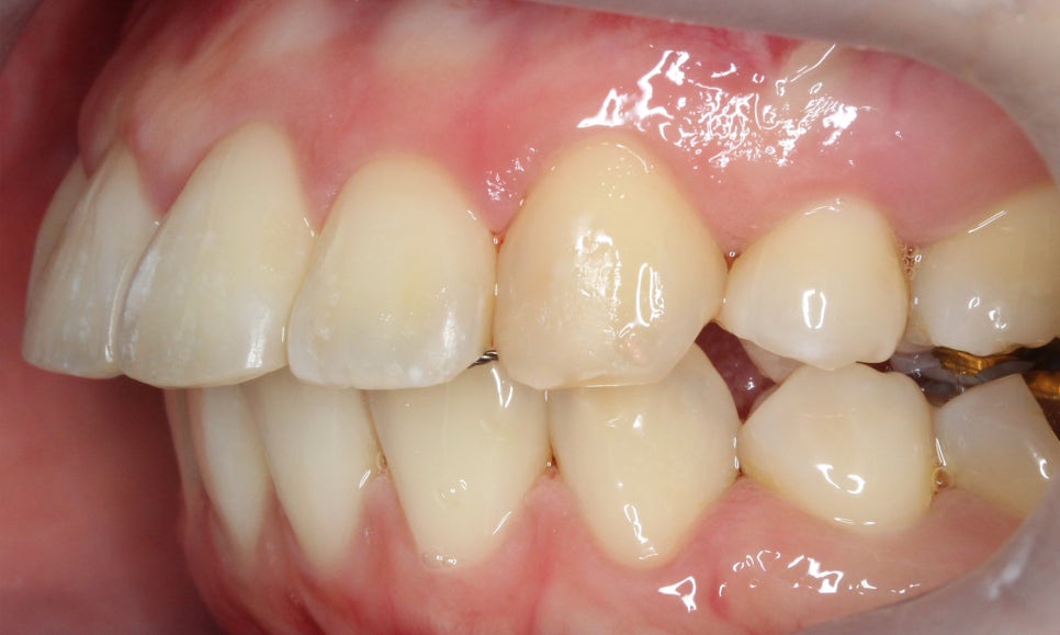 대치동치과 입툭튀 집어넣는 교정 관련 이미지 12