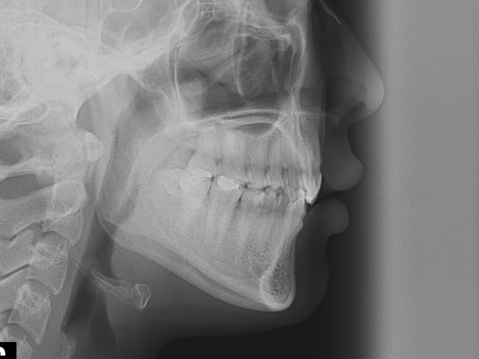 덧니치아 앞니교정 4개월 교정 완료! by. 투디치과(2D치과) 관련 이미지 6