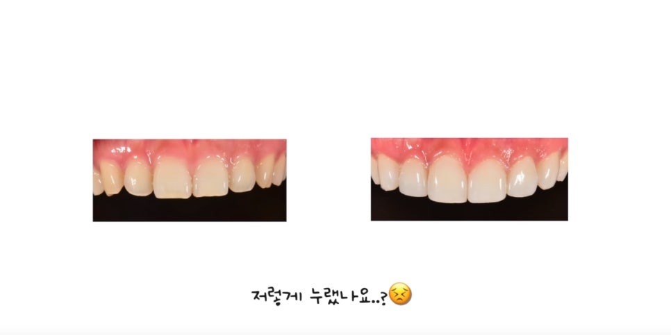 무삭제 라미네이트, 쎄라필름(TheraFilm)후기_유튜버Coco Riley님 by.2D치과(투디치과) 관련 이미지 15