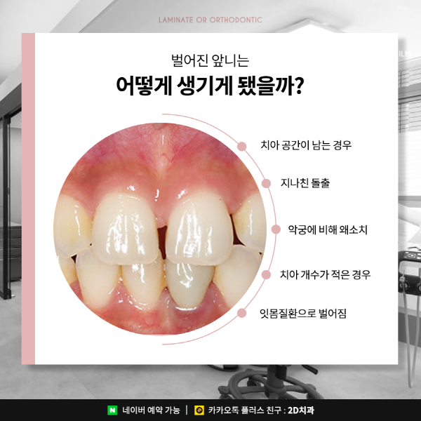 벌어진앞니는 라미네이트? 치아교정? 이렇게 선택하세요 관련 이미지 2