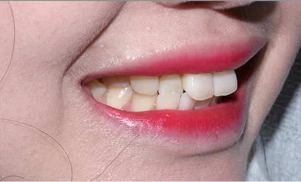 2D치과 2D교정으로 4개월만에 덧니 개선! 관련 이미지 7