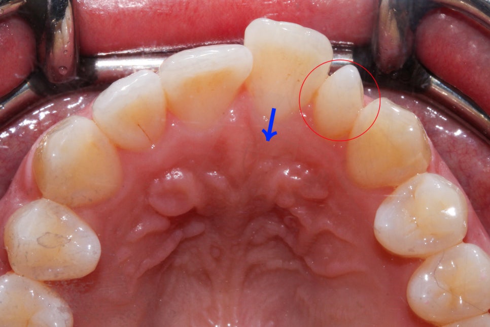 왜소치 뻐드렁니 교정 신논현역치과에서 관련 이미지 6