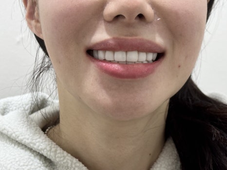 무삭제라미네이트 블랙필름 케이스 비포 에프터 후기 관련 이미지 3