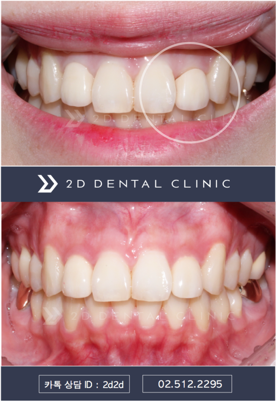 라미네이트에서 중요한 것은..심미적 요소, 블링스 관련 이미지 9