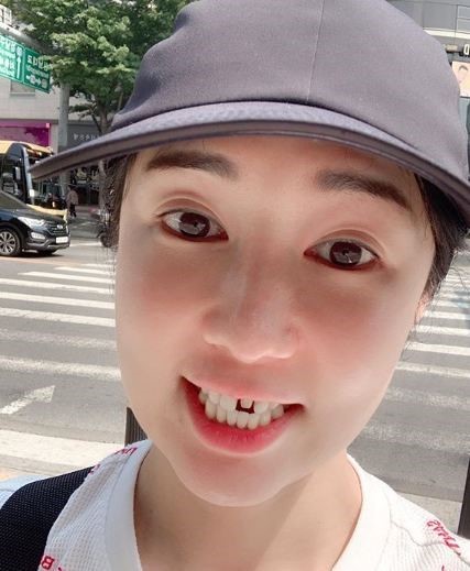 연예인 시술 치아 무삭제라미네이트 2D치과의 독자적인 블랙필름 관련 이미지 3