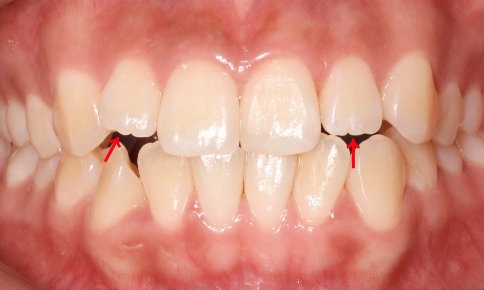 톱니모양 치아를 매끄러운 치아모양으로 개선하는 방법! (마멜론치아) 관련 이미지 1