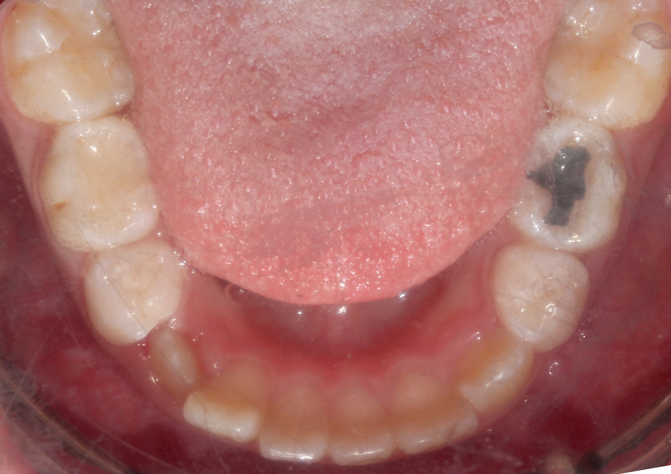 (2D)투디치과: 성장기 어린이 비발치 부정교합 후기 과정. 관련 이미지 6