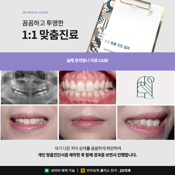 수지처럼 토끼앞니라면? 2D부분교정으로 개선 가능 관련 이미지 5