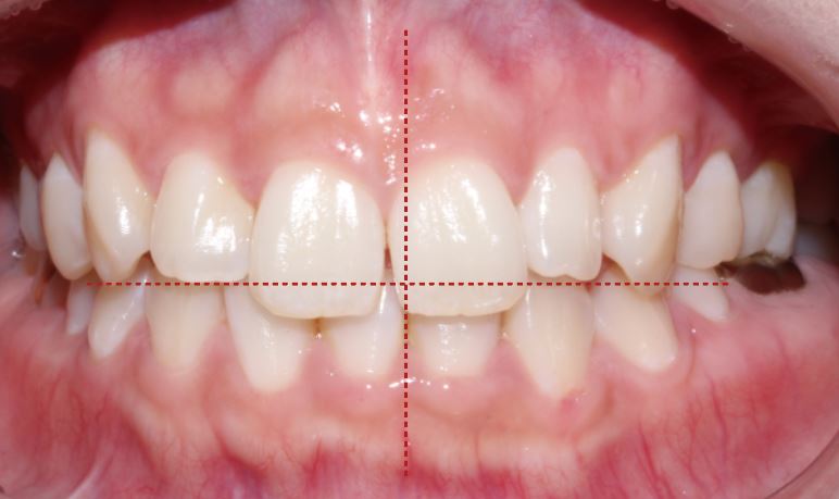 우디의 교정일기ㅣ토끼이빨 치아교정(ft.클리피씨 전체교정) 관련 이미지 6