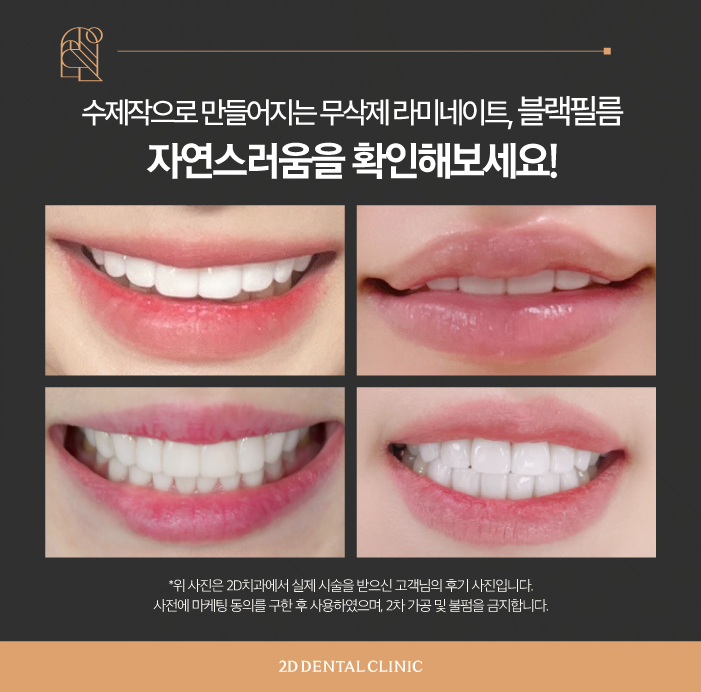 무삭제라미네이트후기 투디치과 블랙필름 탄생 과정 관련 이미지 8