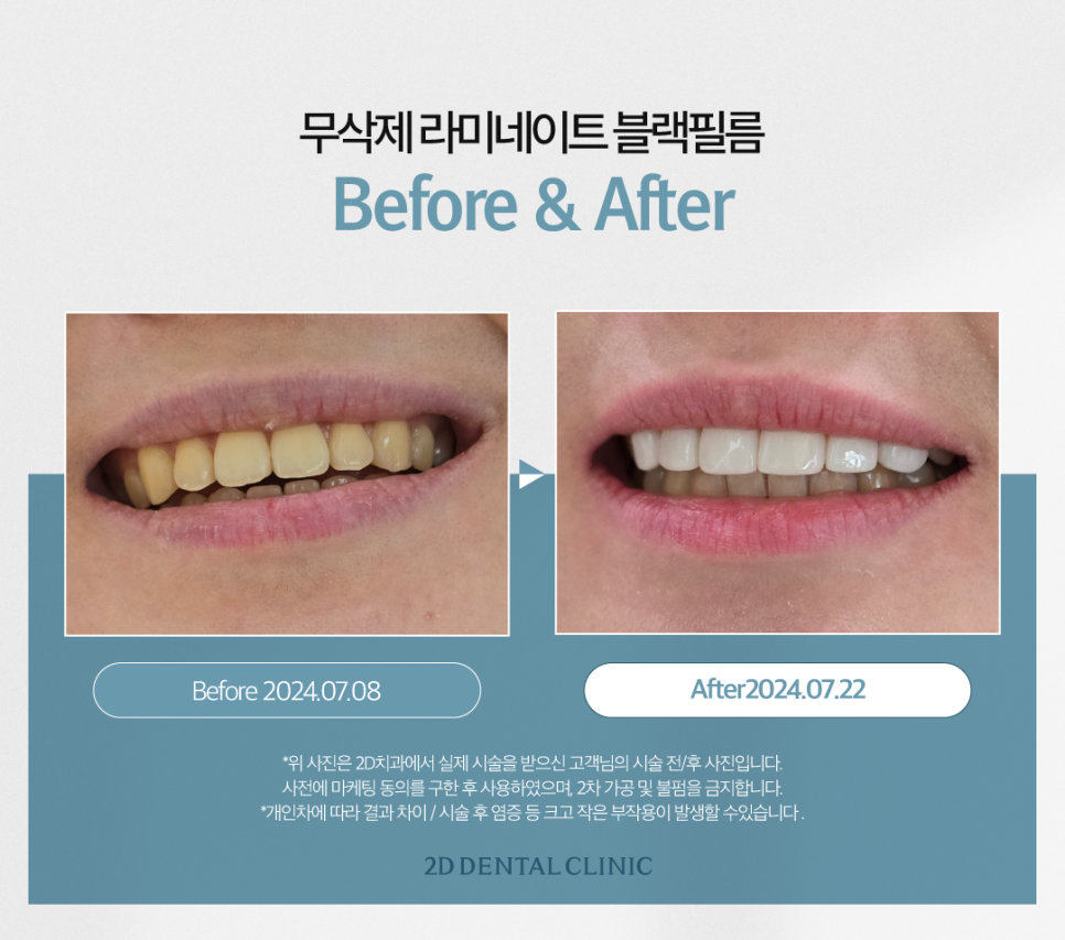 치과라미네이트 치아성형 이 손상 줄이고 심미성 높이고 관련 이미지 9