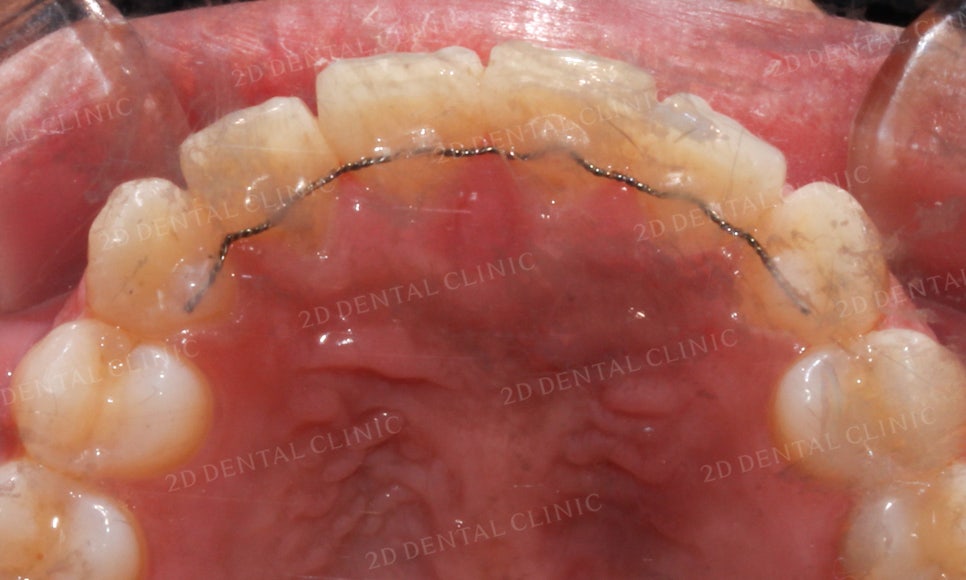 [2D교정] 나비치아, 앞니교정 설측교정으로 빠르게 하는 방법! by.2D치과(투디치과) 관련 이미지 16