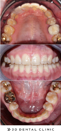 돌출입 유형 및 증상, 치과 내원 전 자가진단! 관련 이미지 7