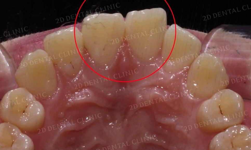 강남역 치과에서 앞니부분 설측 2D(투디)교정으로 토끼앞니 탈출한 후기 관련 이미지 6
