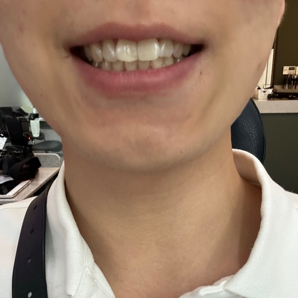 나비치아 치아교정으로 반듯한 치아로 개선 관련 이미지 9