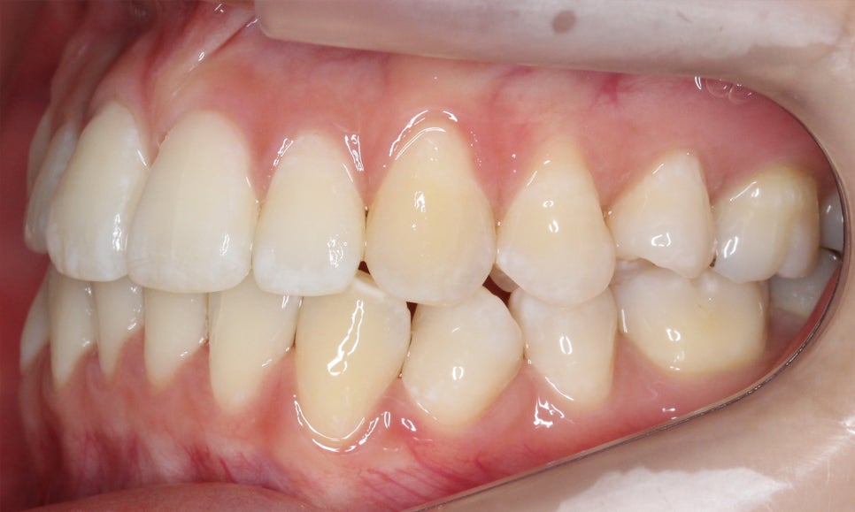 신논현치과 자가결찰브라켓 장점 관련 이미지 14