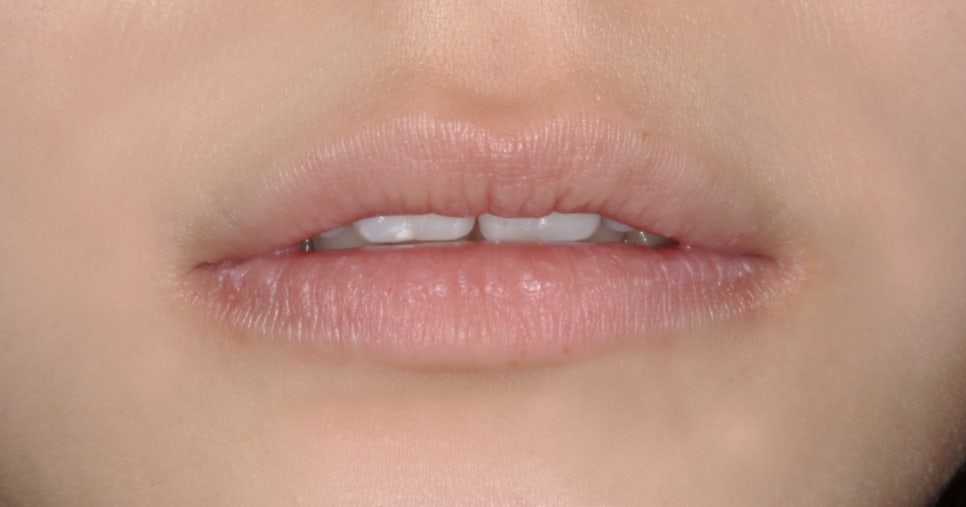 교정일기:앞니 부분 블링스(라미네이트) 심리보철 진료과정 후기 관련 이미지 1