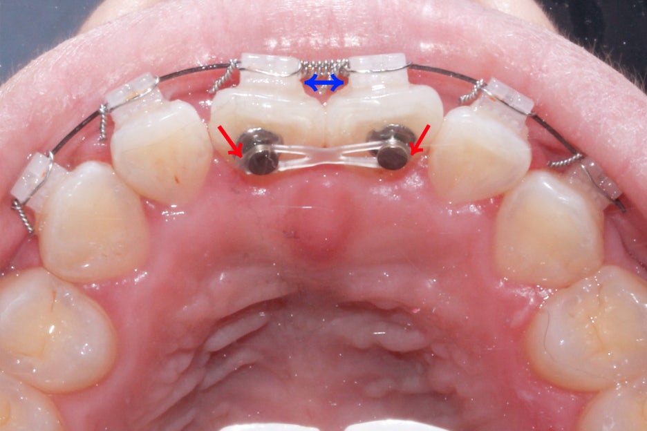 옥니교정 방법! 세라믹교정 Case 관련 이미지 8