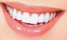 치아삭제 없는 블랙필름 무삭제라미네이트가격 관련 이미지 7