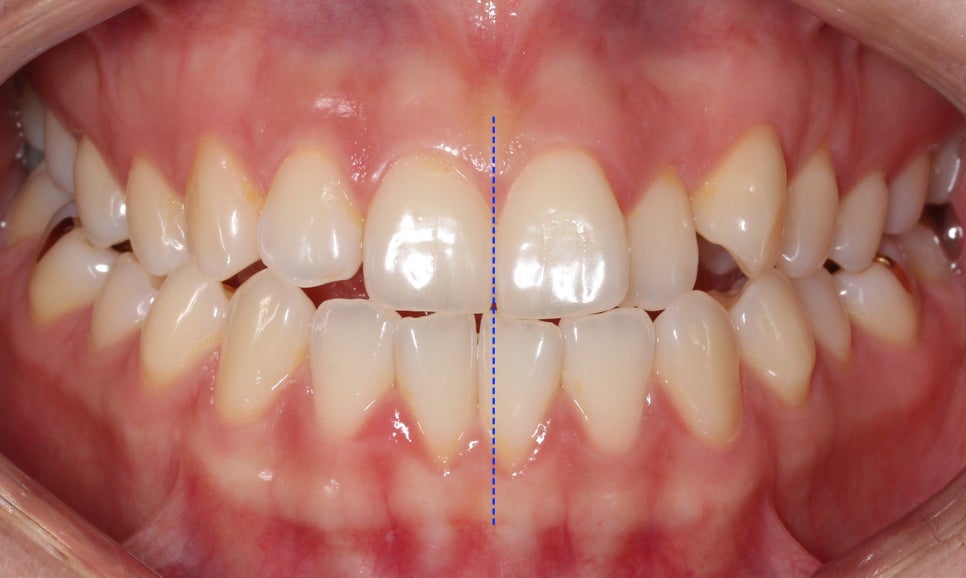 절단교합 클리피씨 교정 방법 관련 이미지 1