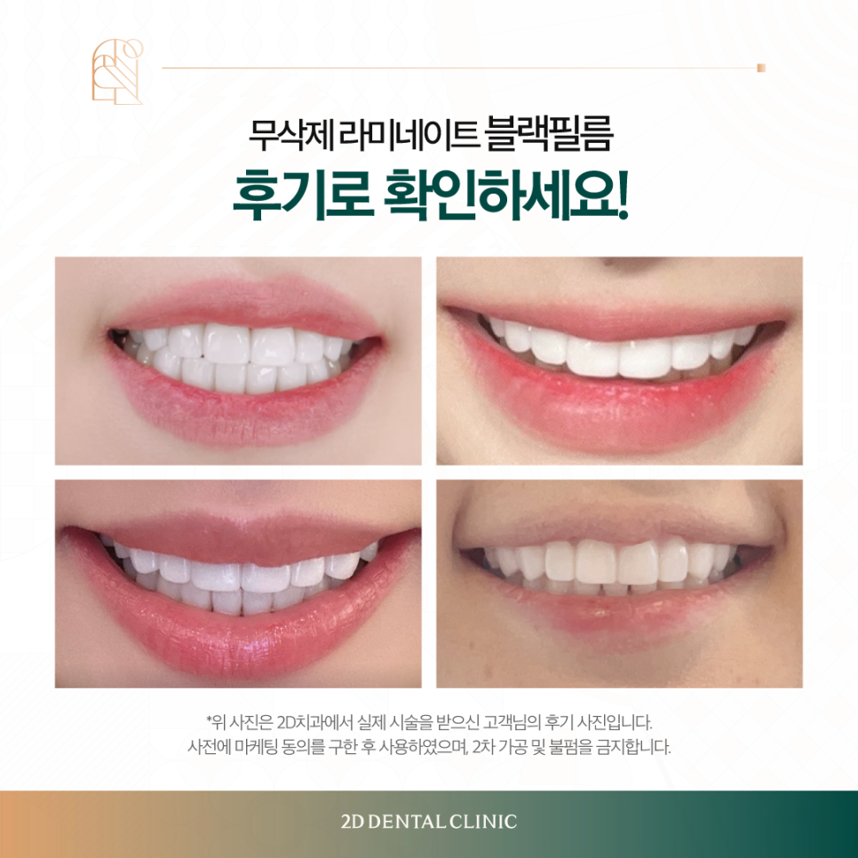 강남라미네이트 앞니교정 블랙필름 이렇게 만들어집니다! 관련 이미지 7