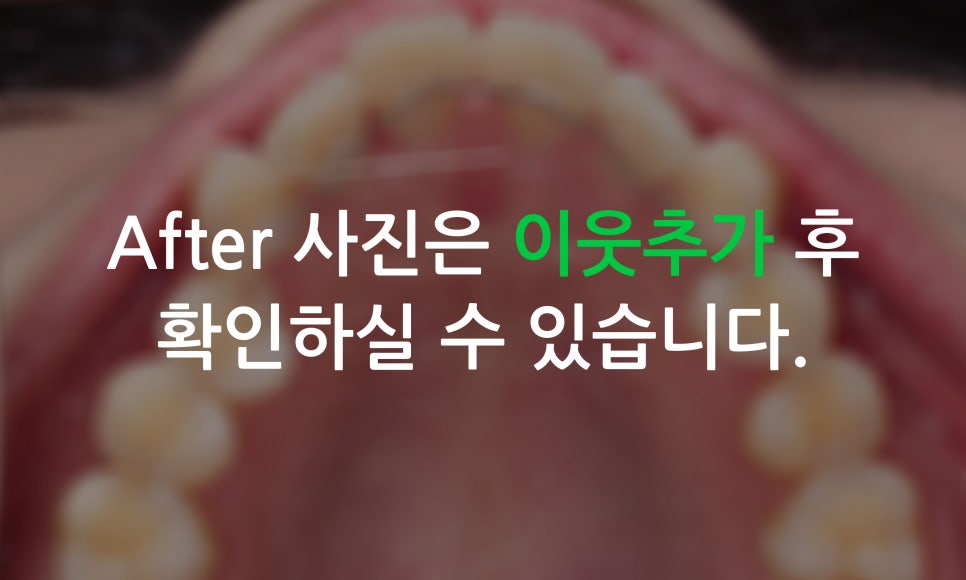 앞니틀어짐을 교정하는 방법은? (2D교정-설측교정) 관련 이미지 7