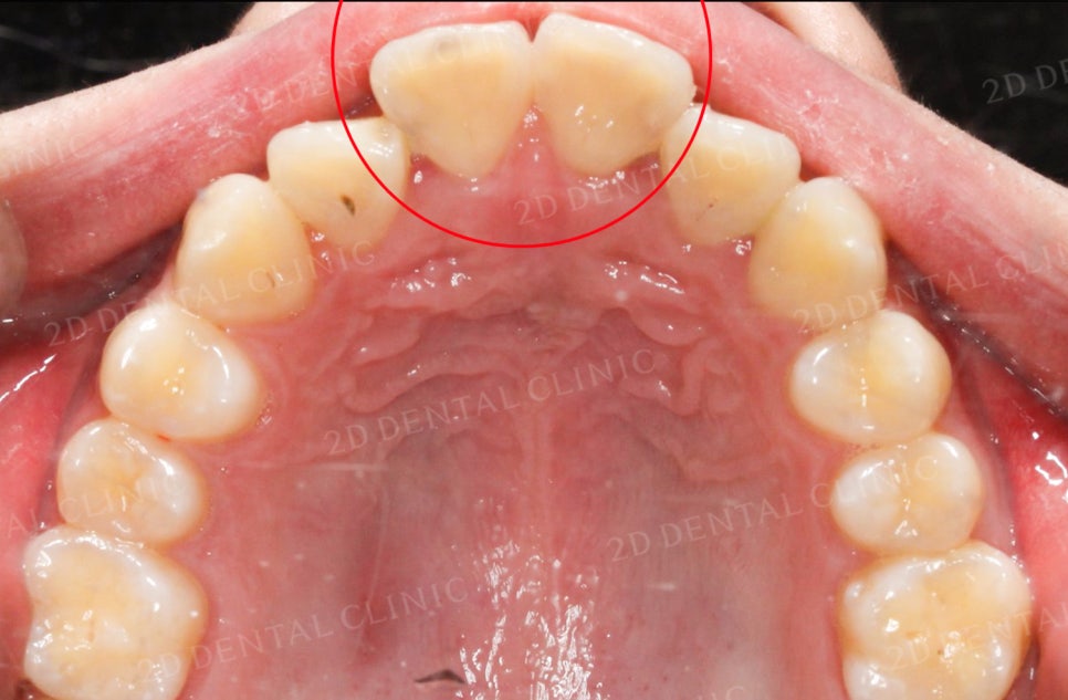 [앞니교정] 토끼앞니교정, 클리피씨 교정으로 완벽하게! by.투디치과(2D치과) 관련 이미지 6