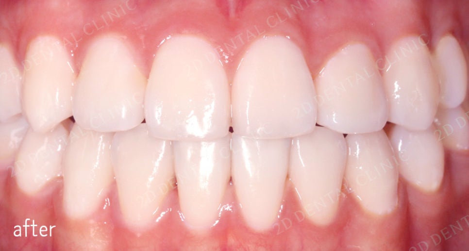 우디의 교정일기ㅣ덧니 치아교정 후기 (feat.부정교합) 관련 이미지 3