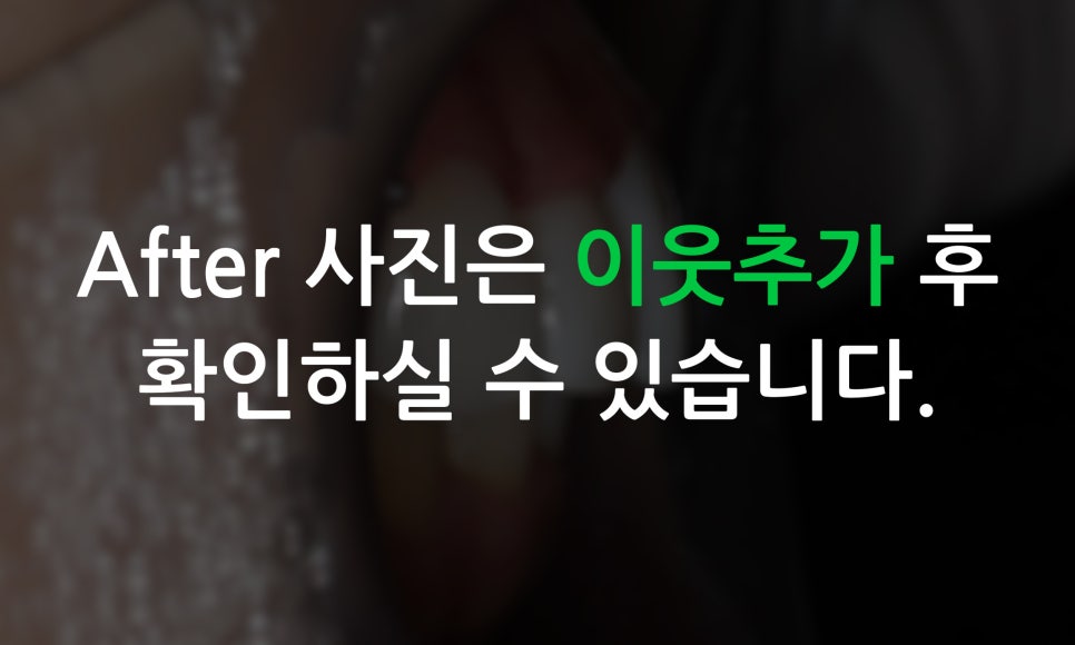 송곳니덧니 교정과 왜소치 세라필름을 한번에! 관련 이미지 8