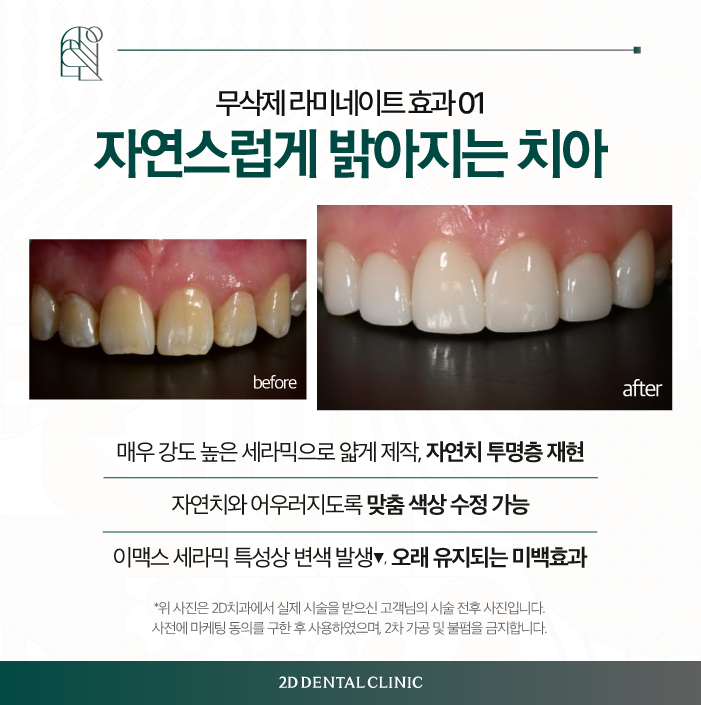 치아 무삭제 라미네이트 블랙필름 효과, 만족도는? 관련 이미지 4